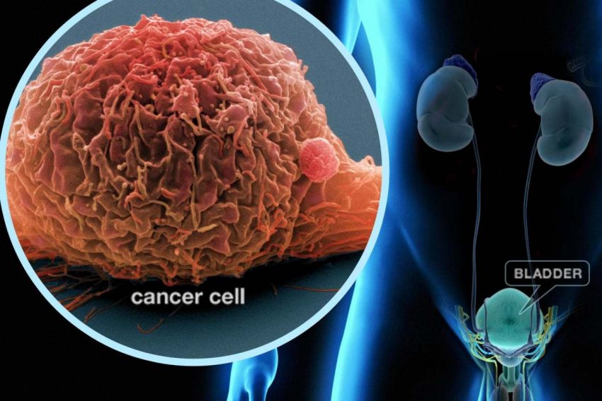 Bladder Cancer, Symptoms, Treatment, Prevention. 