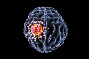 Brain Cancer Symptoms, Treatment, Prevention.
