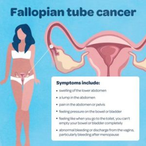 Fallopian Tube Cancer Statistics, Symptoms, Treatment & Prevention