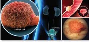 Bladder Cancer Symptoms, Statistics, Treatment & Prevention