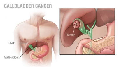 Gallbladder Cancer Statistics, Symptoms, Treatment & Prevention