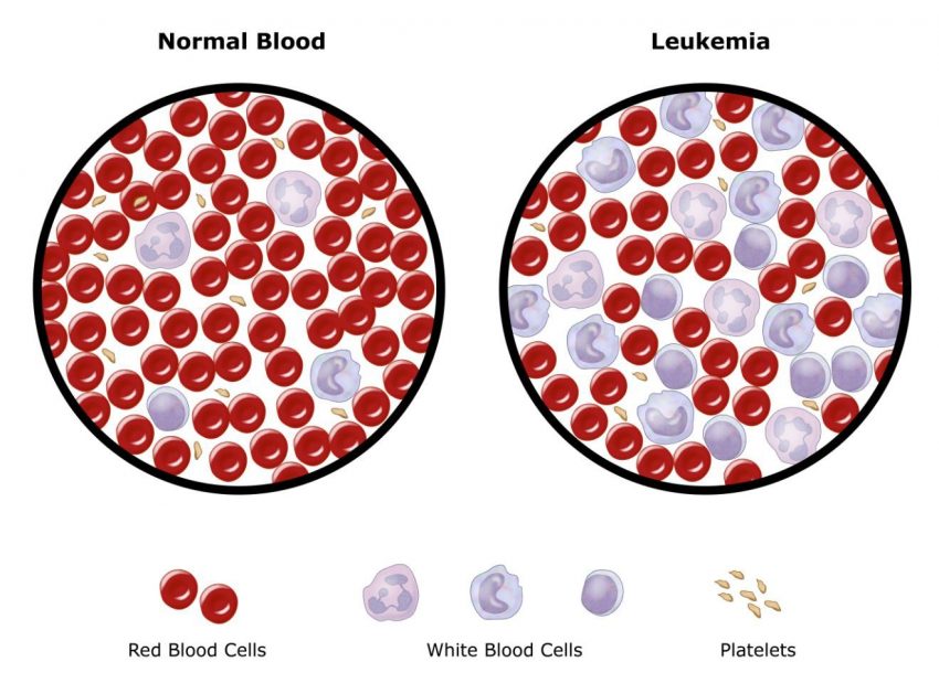 Leukemia Statistics, Symptoms, Treatment & Prevention