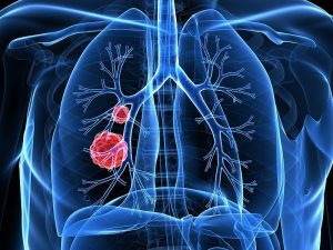 Lung Cancer Statistics, Causes, Symptoms & Treatment