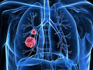 Lung Cancer Statistics, Causes, Symptoms & Treatment