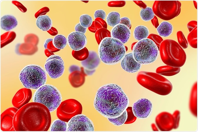 Leukemia Statistics, Symptoms, Treatment & Prevention