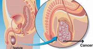 Testicular Cancer Causes, Symptoms, Treatment & Prevention