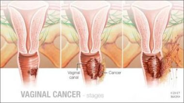 Vaginal Cancer Causes, Symptoms, Treatment & Prevention