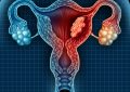 Uterine Cancer Statistics, Symptoms, Treatment & Prevention