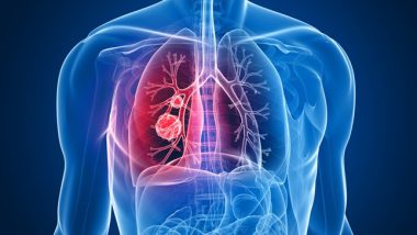 Non-Small Cell Lung Cancer Causes, Symptoms, Treatment & Prevention