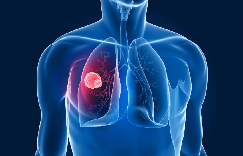 Non Small Cell Lung Cancer Causes Symptoms Treatment And Prevention