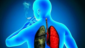 Small Cell Lung Cancer Risk Factors, Symptoms, Treatment & Prevention