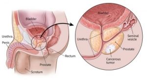 Prostate Cancer Statistics, Symptoms, Treatment & Prevention