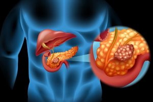 Pancreatic Cancer Statiatics, Symptoms, Treatment & Prevention