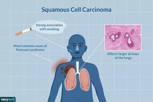 Squamous Cell Carcinoma Causes, Symptoms, Treatment & Prevention
