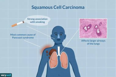 Squamous Cell Carcinoma Causes, Symptoms, Treatment & Prevention