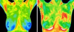 Alternative Cancer Therapy – Thermography