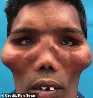 Suresh Lion Face Syndrome