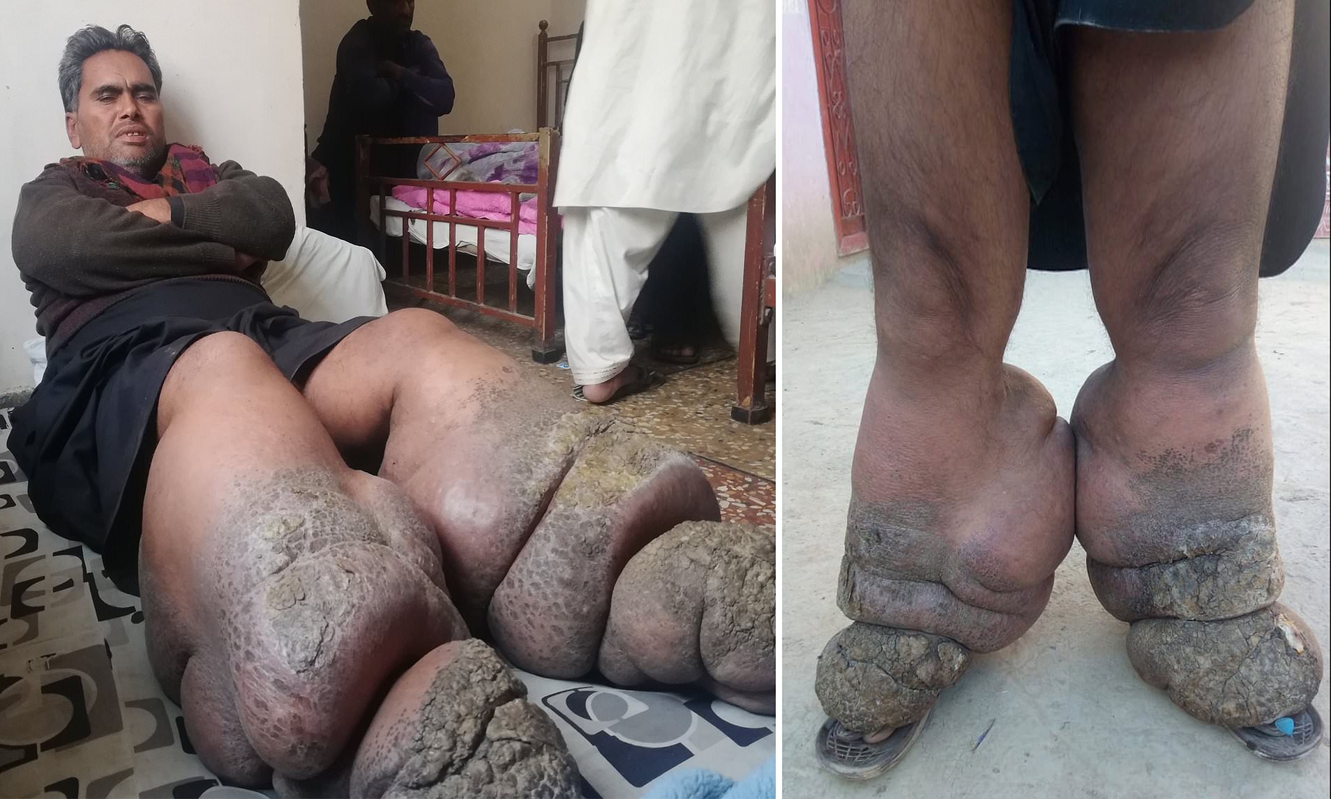 Man’ Legs Ballooned to 110lbs Due to Worm Infection