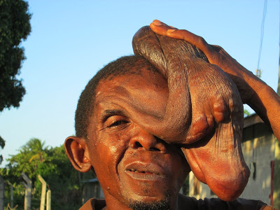 The Tanzania Man with Massive Neurofibromatosis