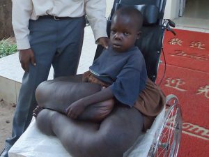 Ugandan Boy Whose Legs Weigh More Than He Does