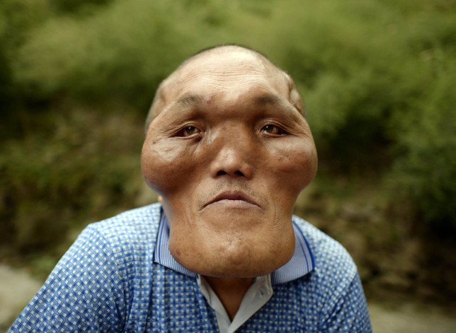 Man With Alien-like Facial Deformities