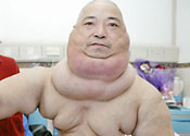 Chine Man with 15kg Neck Tumor