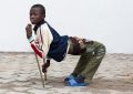 leg deformity