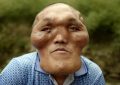 alien-like facial deformity