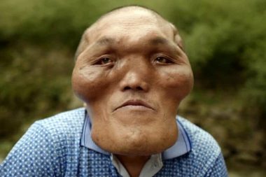 alien-like facial deformity