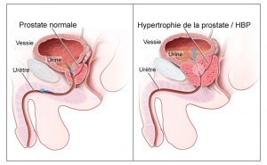 Prostate Health