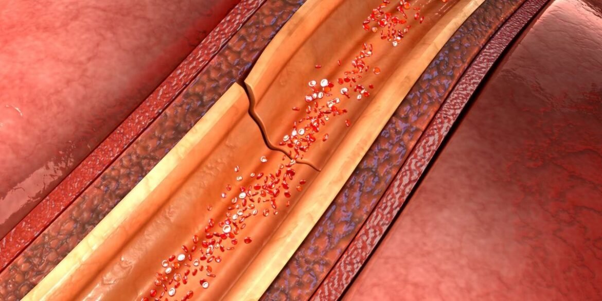 Spontaneous Coronary Artery Dissection 101