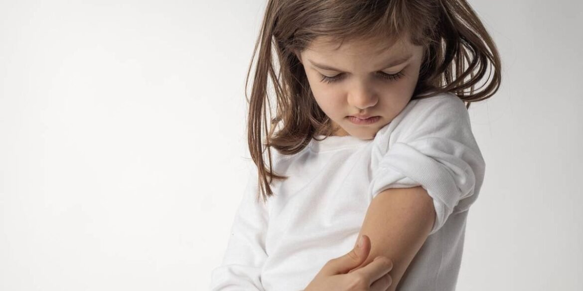 Managing Atopic Dermatitis in Kids Managing Atopic Dermatitis in Kids