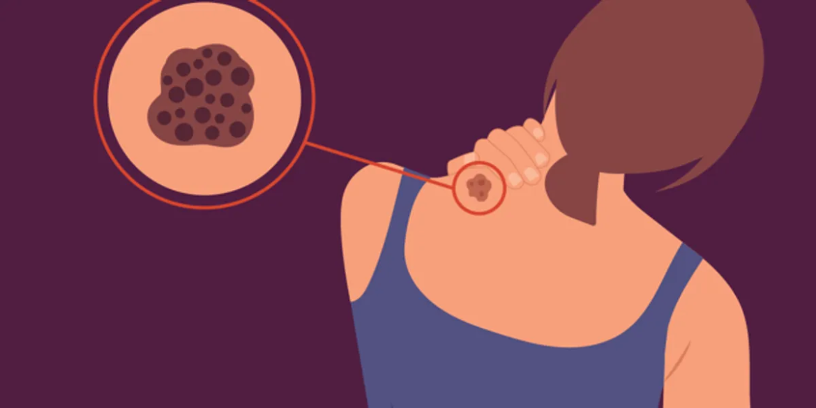 Types of Melanoma - HealthyWomen