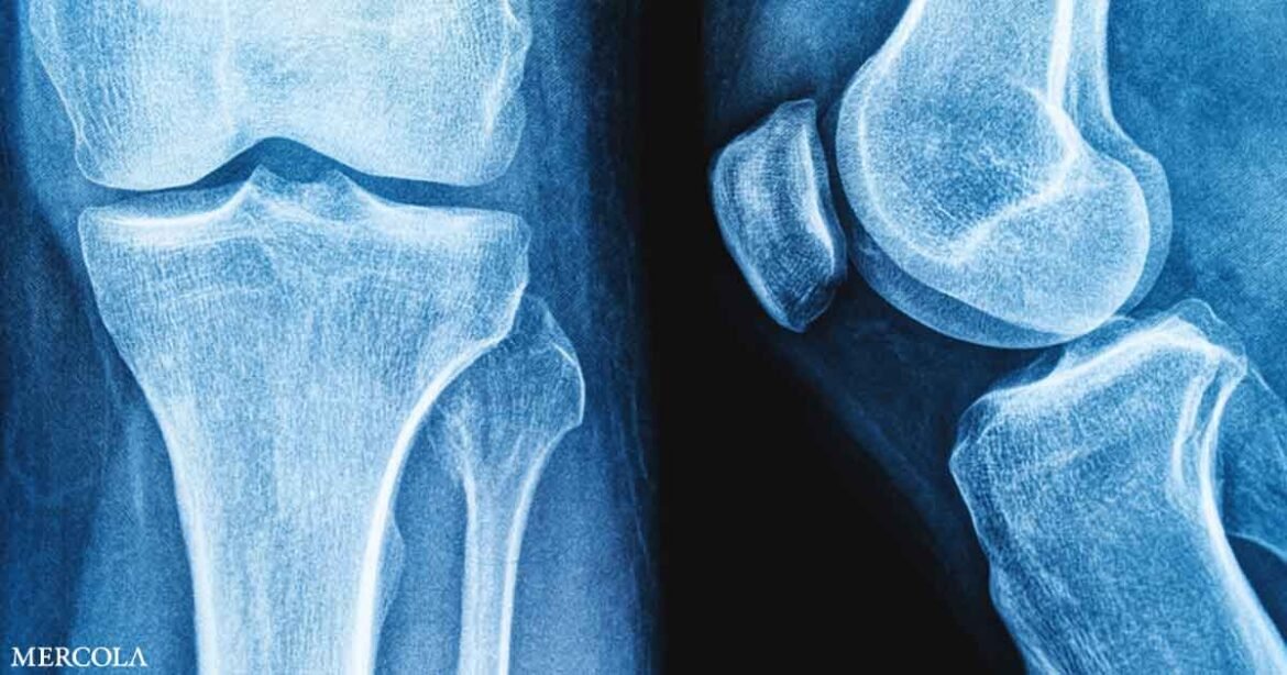 Microplastics Could Be Weakening Your Bones, New Study Finds
