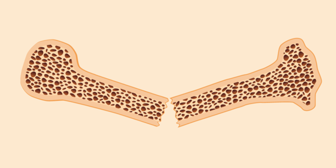 Osteoporosis Treatments - HealthyWomen