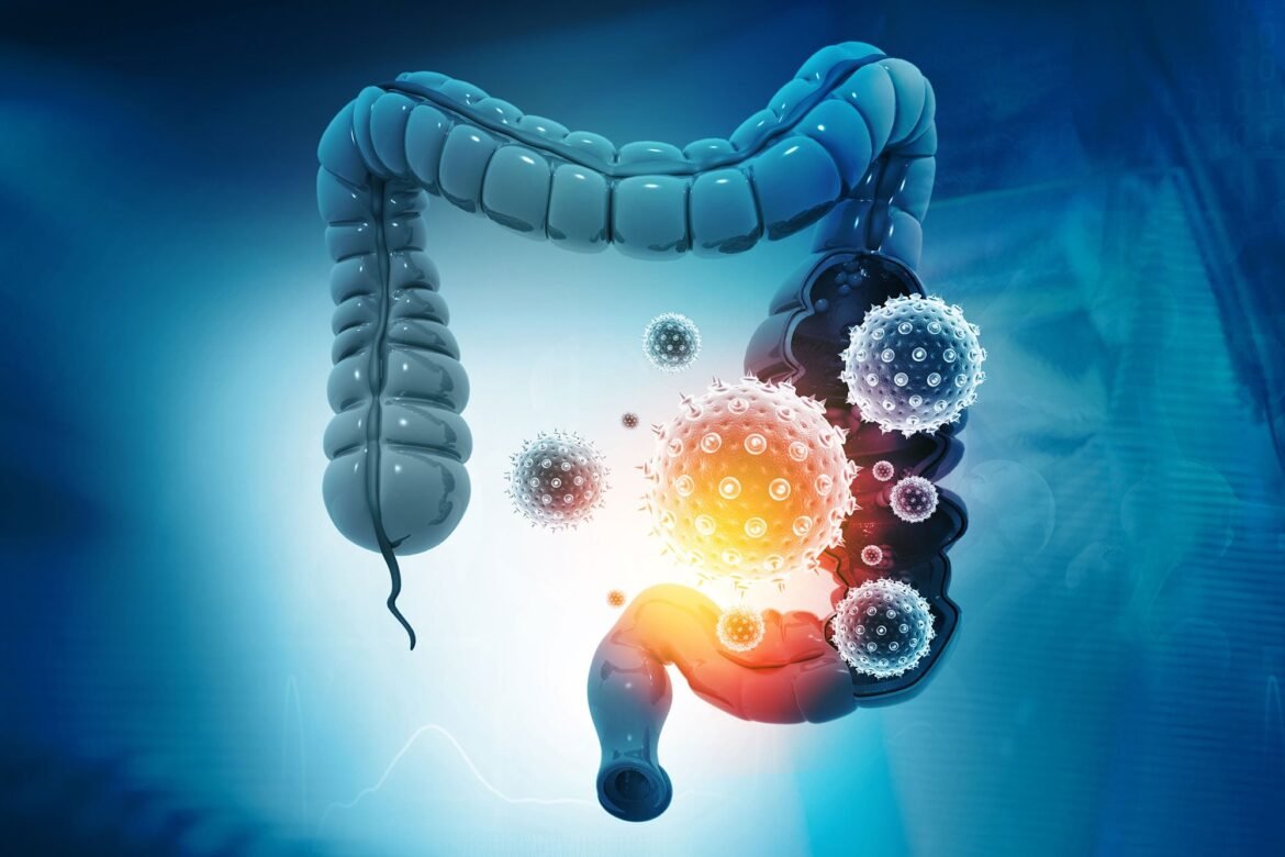 The Immune Chain Reaction That Raises Colon Cancer Risk in IBD