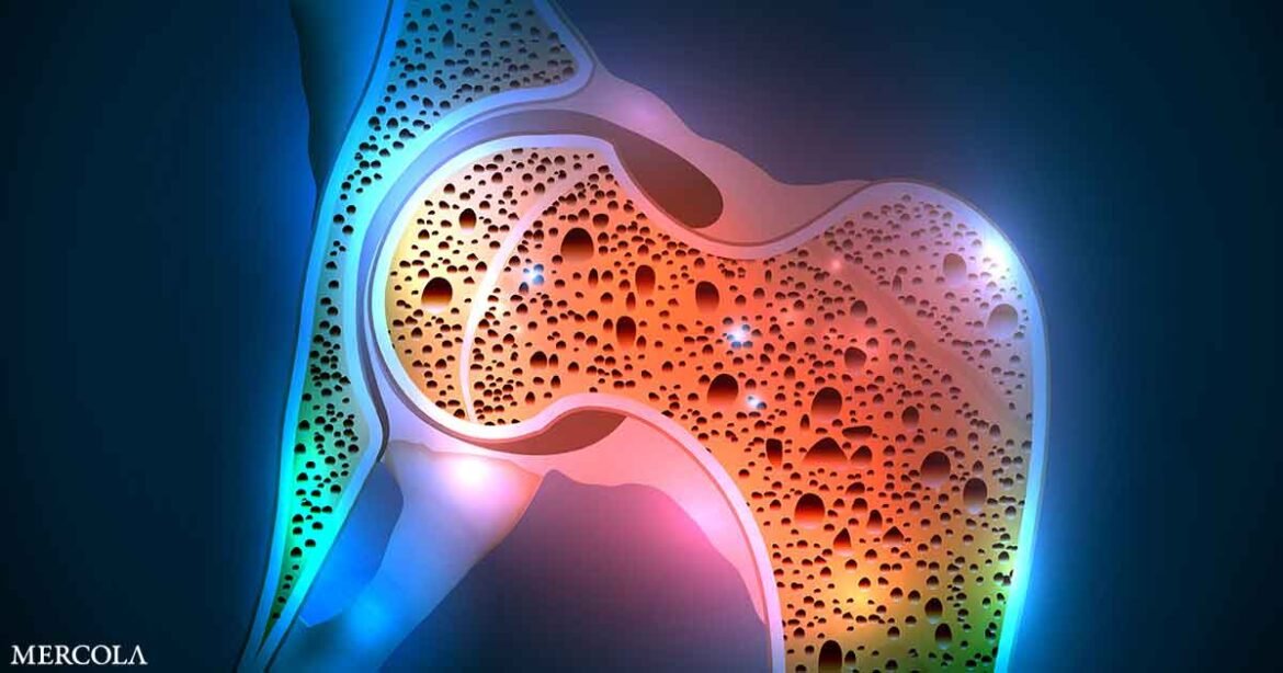 Serotonin Is Both a Biomarker and Driver of Osteoporosis
