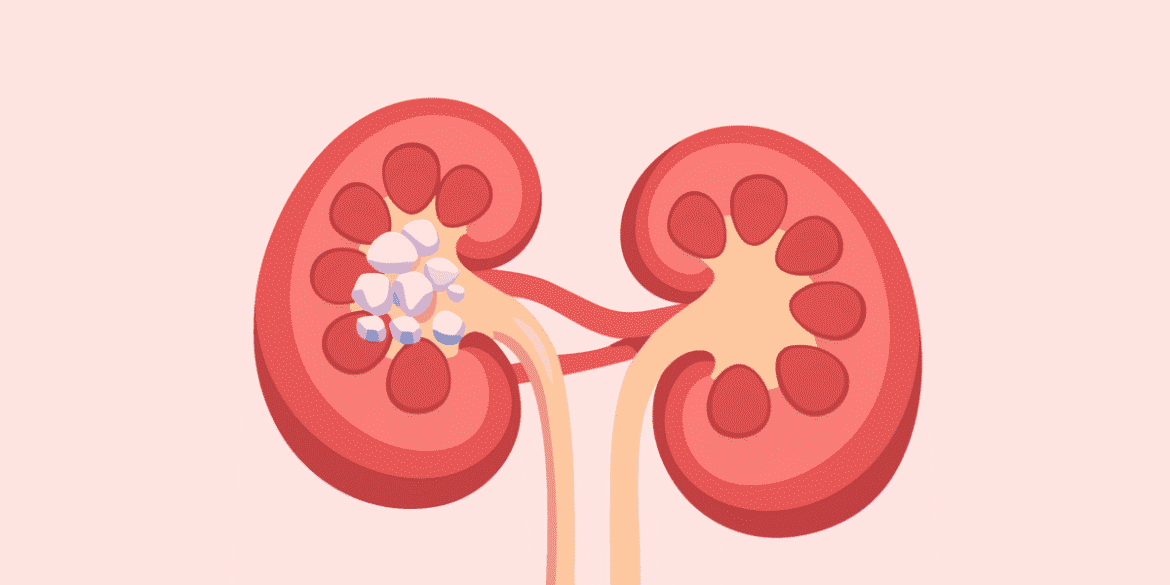 Tratamientos para la hiperoxaluria primaria