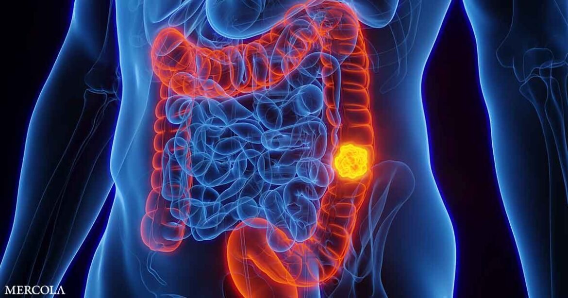Gut Bacteria's Hidden Role in Colon Cancer Risk